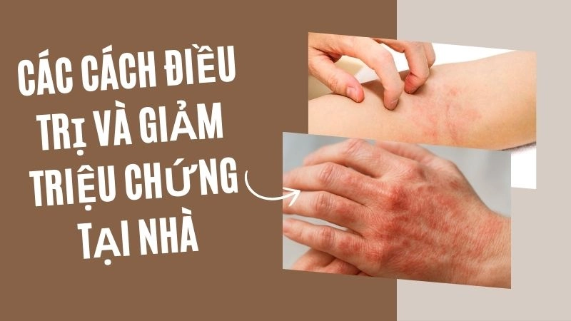 Các cách điều trị và giảm triệu chứng tại nhà