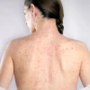 Bệnh Sởi Ở Người Lớn: Nguy Hiểm Tiềm Ẩn Và Cách Nhận Biết Sớm