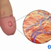Biểu hiện bệnh giang mai ở nam giới và cách nhận biết sớm