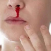 Chảy máu mũi tự nhiên là dấu hiệu bệnh gì? Nguyên nhân và cách xử lý