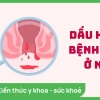 Dấu hiệu bệnh trĩ ở phụ nữ: Nhận biết sớm để điều trị kịp thời