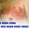 Hình ảnh bệnh zona thần kinh: Nhận biết sớm và phòng tránh