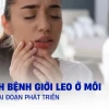 Hình ảnh Giời Leo: Nhận biết, phòng tránh và cách điều trị