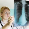 Triệu chứng bệnh lao phổi: Nhận biết sớm và biện pháp phòng ngừa