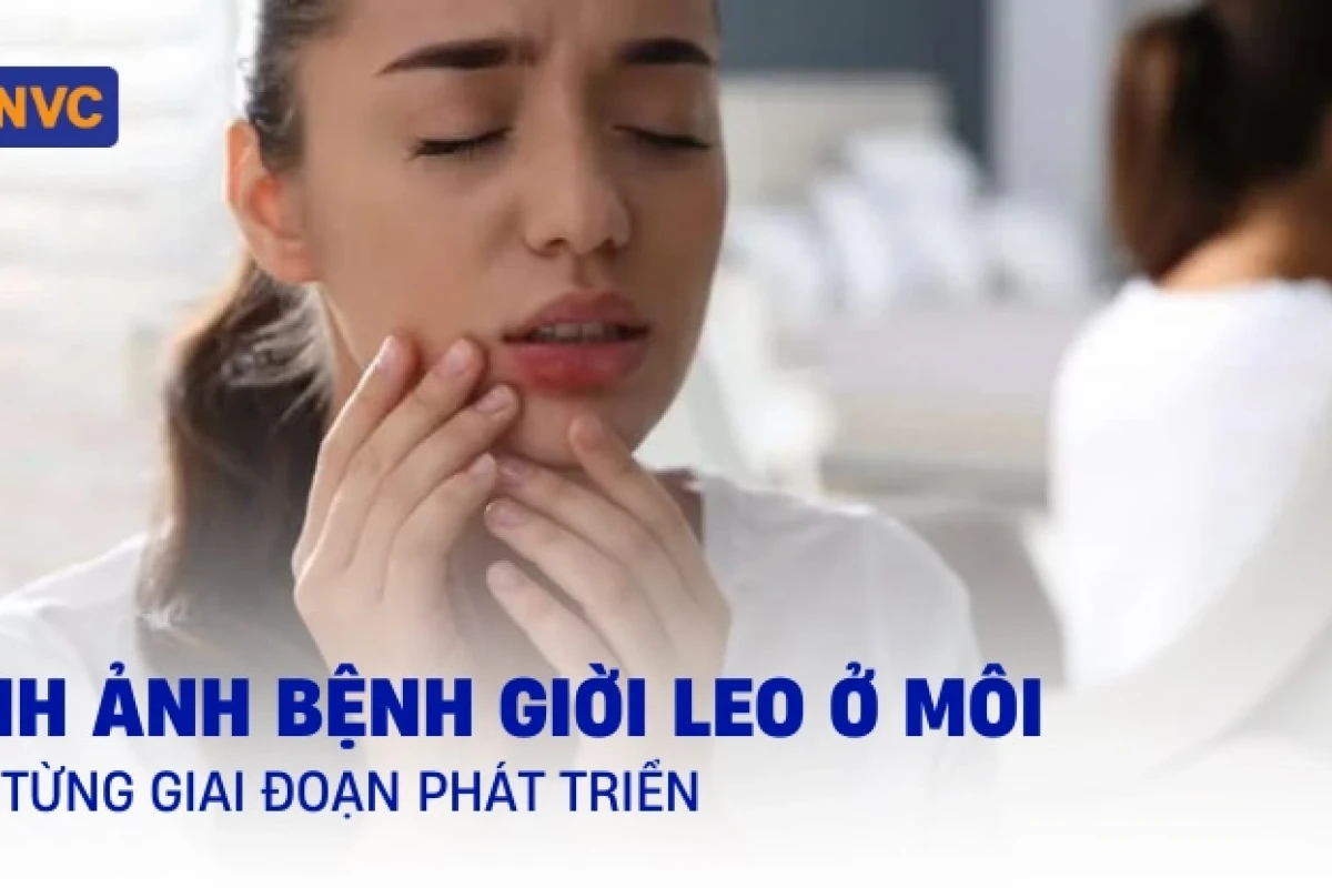 Hình ảnh Giời Leo: Nhận biết, phòng tránh và cách điều trị