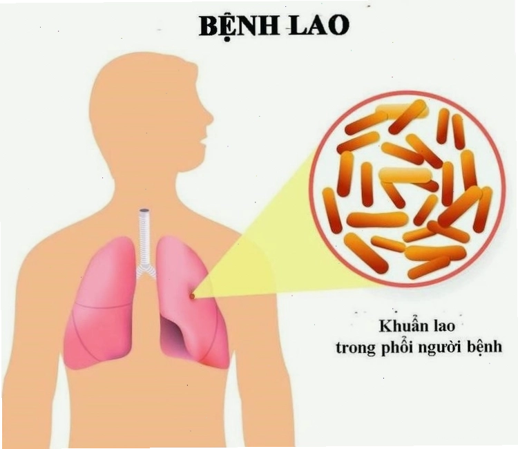 Bệnh lao có thể chữa khỏi trong 8 tháng điều trị liên tục bằng thuốc