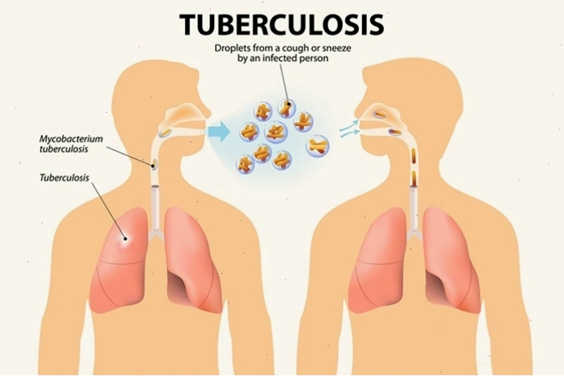 Bệnh lao phổi là một bệnh truyền nhiễm gây ra bởi vi khuẩn lao Mycobacterium tuberculosis