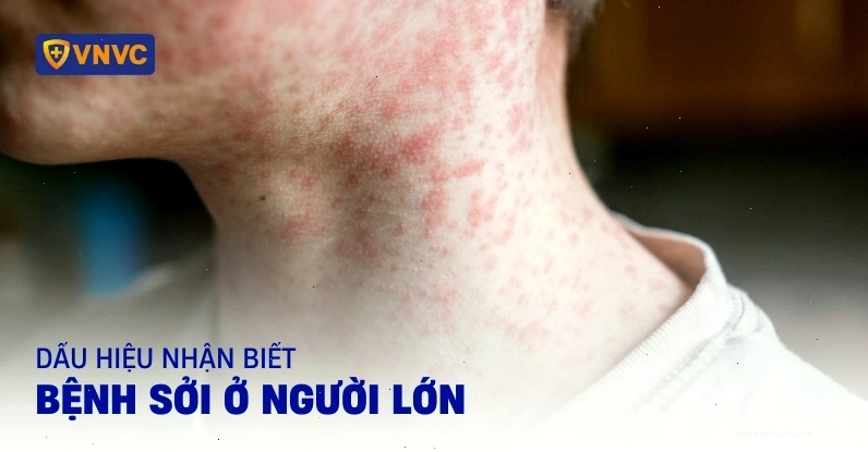 bệnh sởi ở người lớn