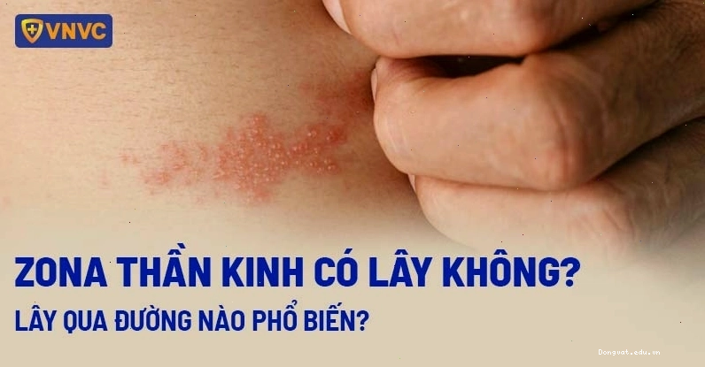Bệnh zona thần kinh có lây không?