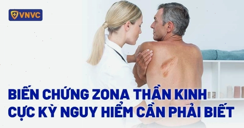 Biến chứng zona thần kinh có thể ảnh hưởng nghiêm trọng đến sức khỏe