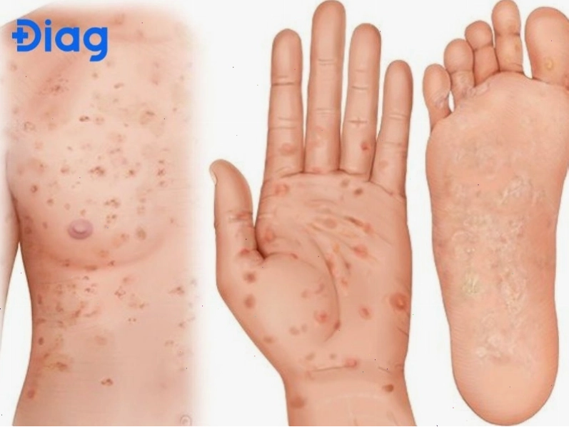 Biểu hiện bệnh giang mai ở nam giới giai đoạn hai với phát ban toàn thân