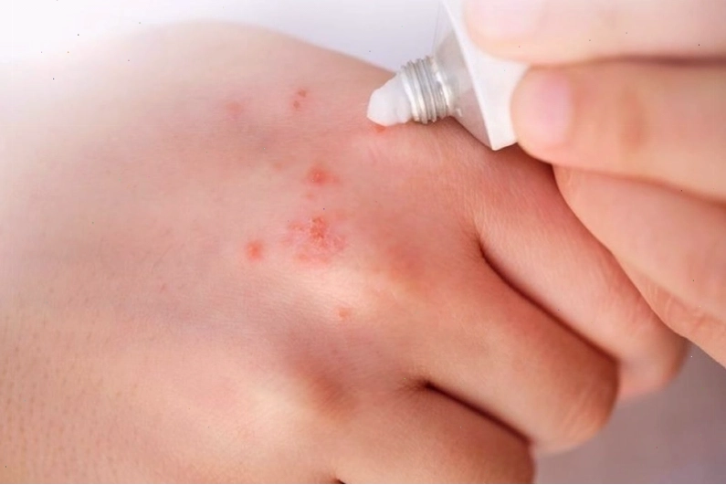 Bọ mạt ký sinh trên gà, gây ảnh hưởng nghiêm trọng đến sức khỏe vật nuôi