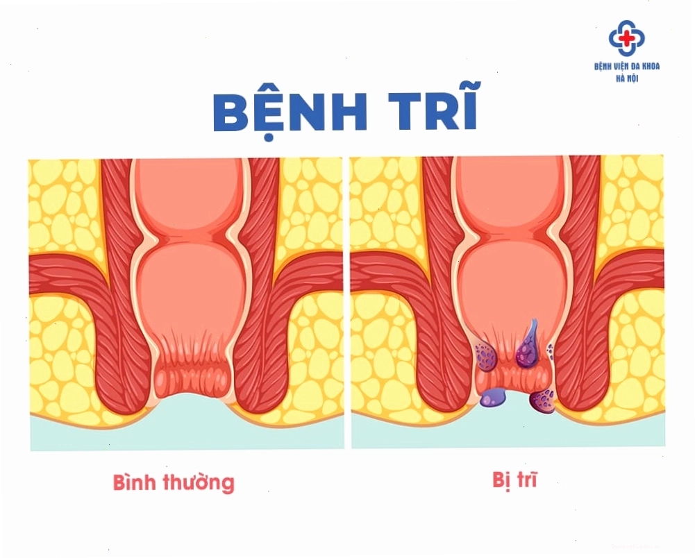 Búi trĩ gây khó chịu và chảy máu ở phụ nữ