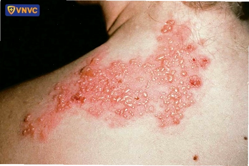 Các biểu hiện đặc trưng của bệnh zona thần kinh trên da