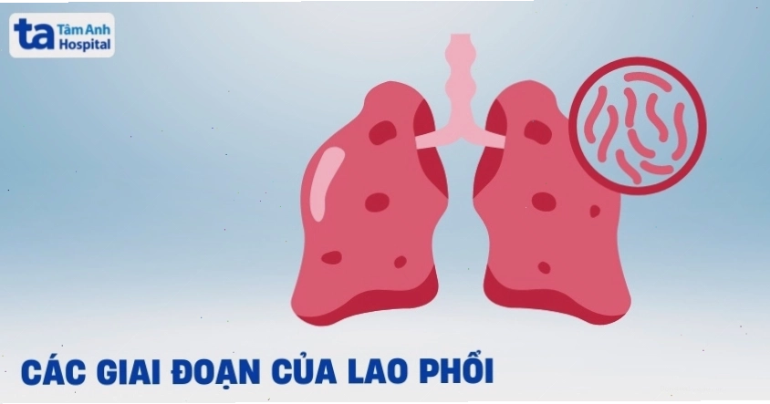 Các giai đoạn của lao phổi và cách nhận biết sớm