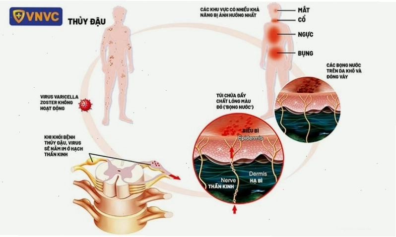 Các nguyên nhân và yếu tố nguy cơ dẫn đến bệnh zona thần kinh