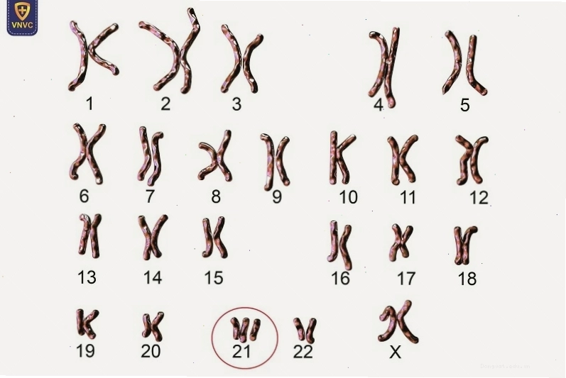 Các yếu tố nguy cơ và cơ chế di truyền của bệnh Down