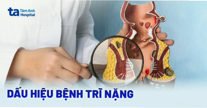 Dấu hiệu bệnh trĩ nội tiến triển nặng