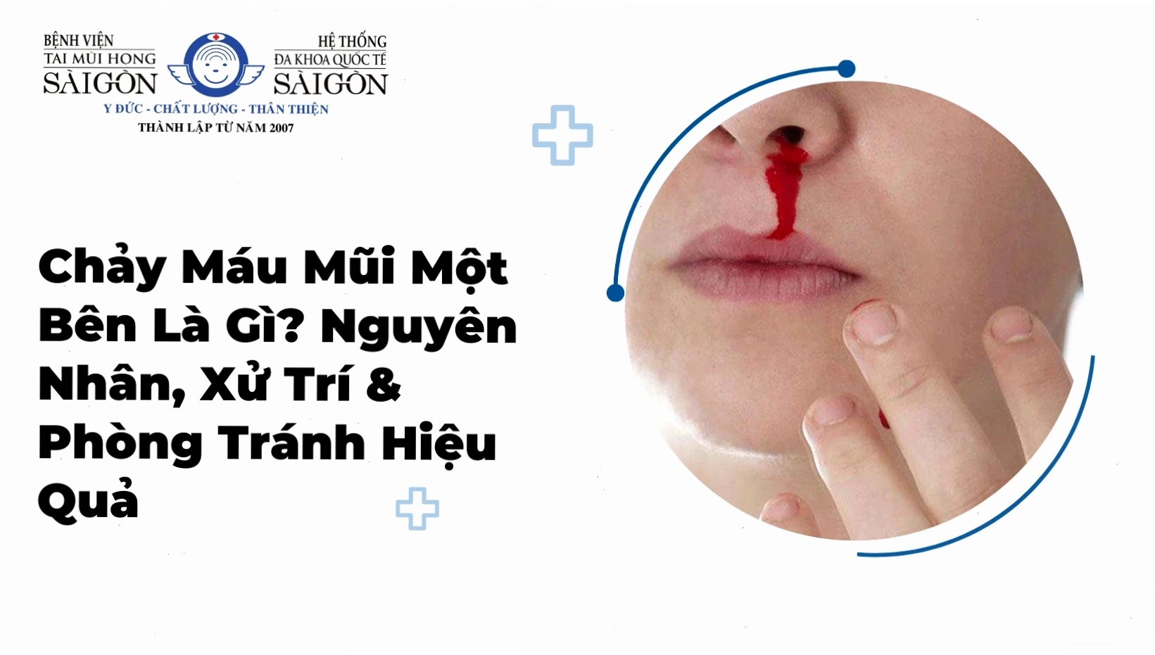 Dùng tay bóp chặt phần mềm của mũi để cầm máu