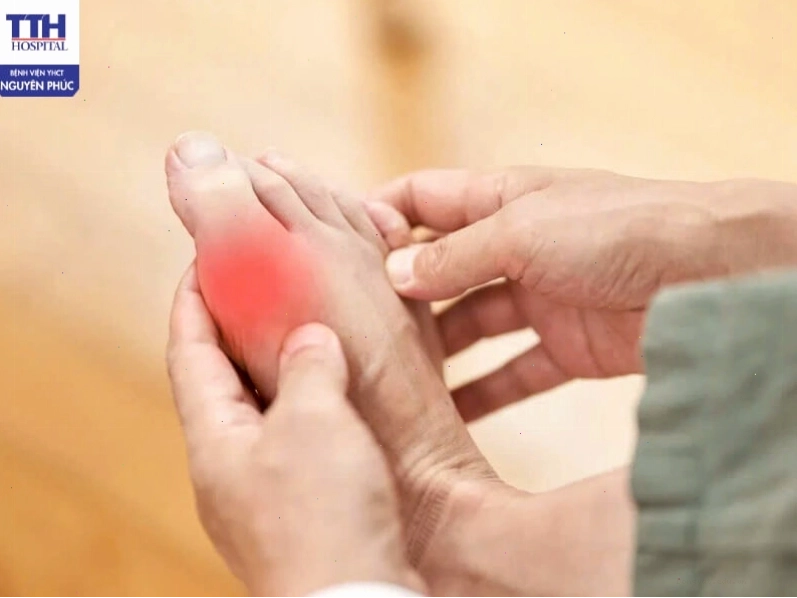 Giai đoạn 2: Cơn gout cấp tính