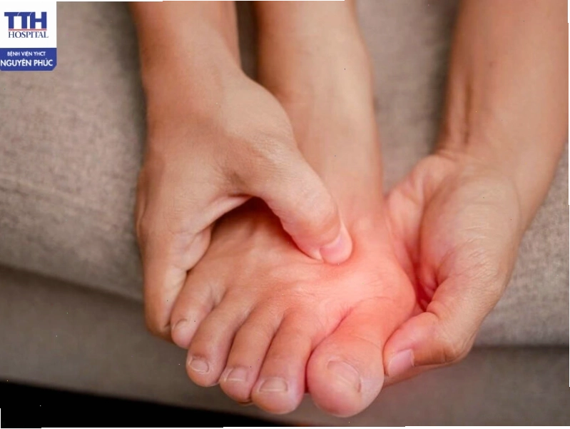 Giai đoạn 4: Gout mạn tính – Biến chứng nặng nề