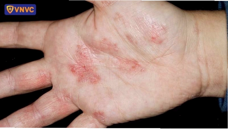 Hình ảnh bệnh zona ở tay