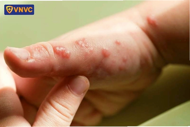 Hình ảnh bị giời leo ở cánh tay với các nốt mụn nước đặc trưng
