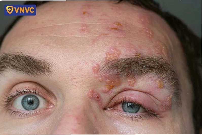 Hình ảnh bị giời leo ở mặt, ảnh hưởng đến vùng mắt và trán