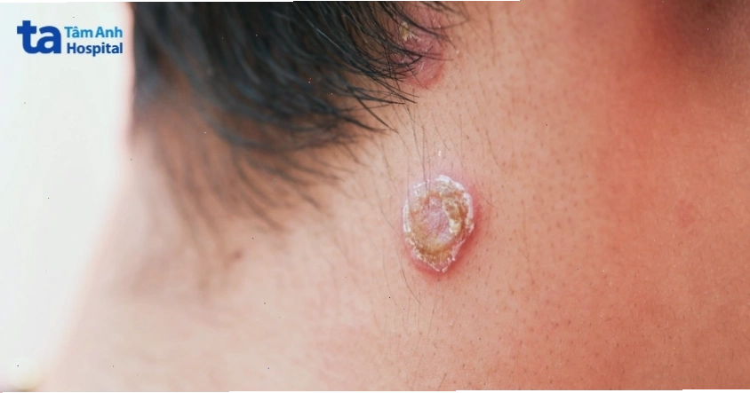 Hình ảnh gôm giang mai khi bị vỡ gây loét trên da