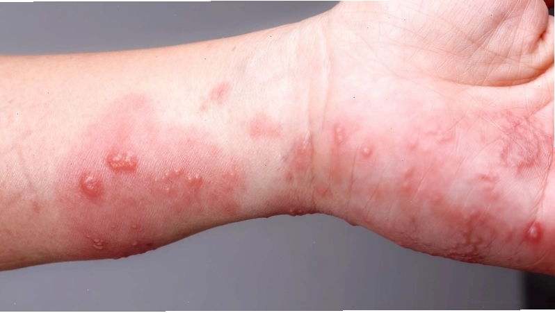 Hình ảnh minh họa bệnh zona thần kinh ở tay