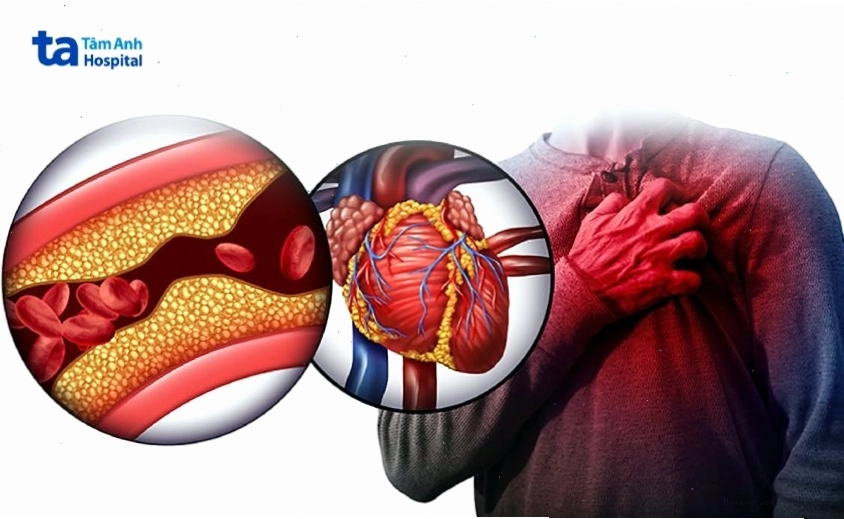 Hình ảnh minh họa nguy cơ nhồi máu cơ tim và đột quỵ não do máu nhiễm mỡ