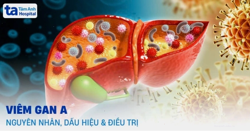 Hình ảnh minh họa virus viêm gan A và các triệu chứng bệnh