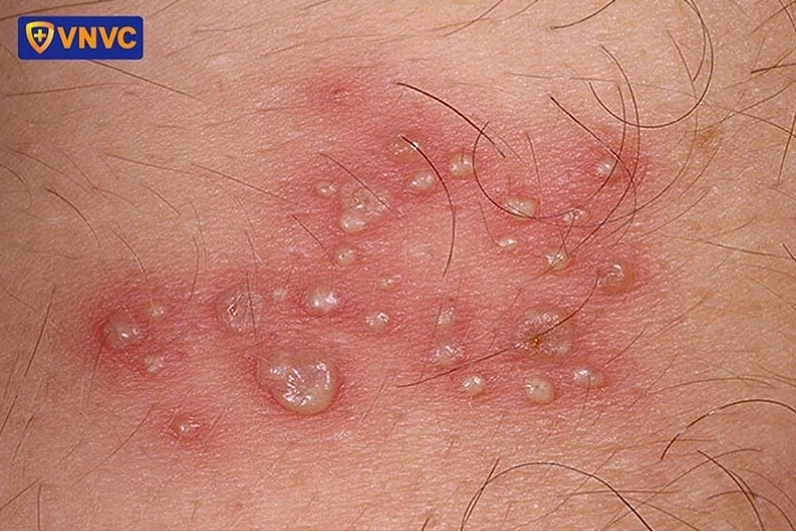 Hình ảnh thực tế một người bị giời leo với các mụn nước phồng rộp