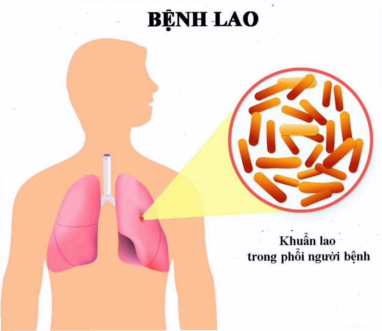 Hình ảnh vi khuẩn lao trong phổi người bệnh