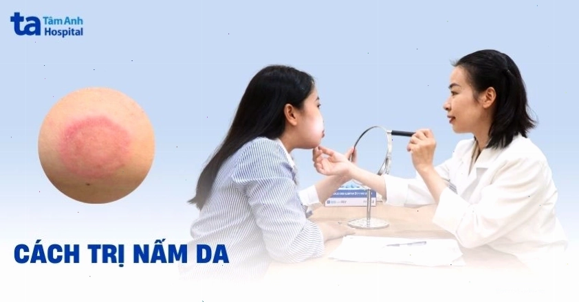 Hướng dẫn cách trị nấm da an toàn và hiệu quả