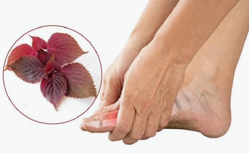 Lá tía tô có thể làm giảm enzym xanthin oxidase gây ra bệnh gout