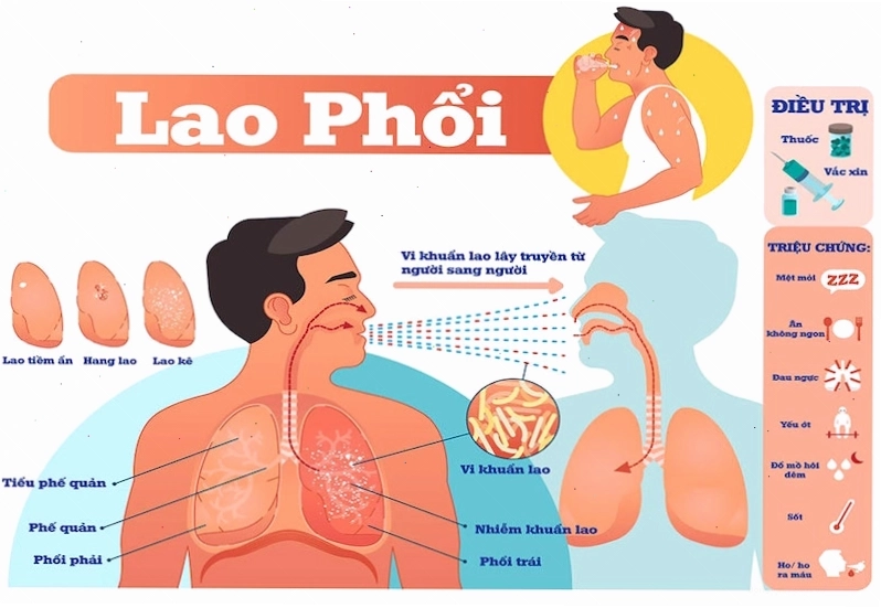 Lao phổi là bệnh nguy hiểm, cần điều trị sớm và đúng cách