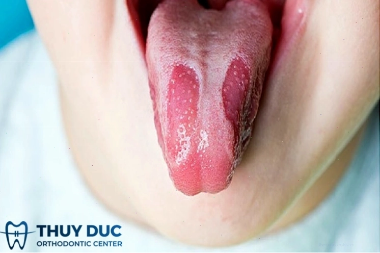 Lưỡi bản đồ có thể có các vùng sẫm màu gây nhầm lẫn với lưỡi bị đen