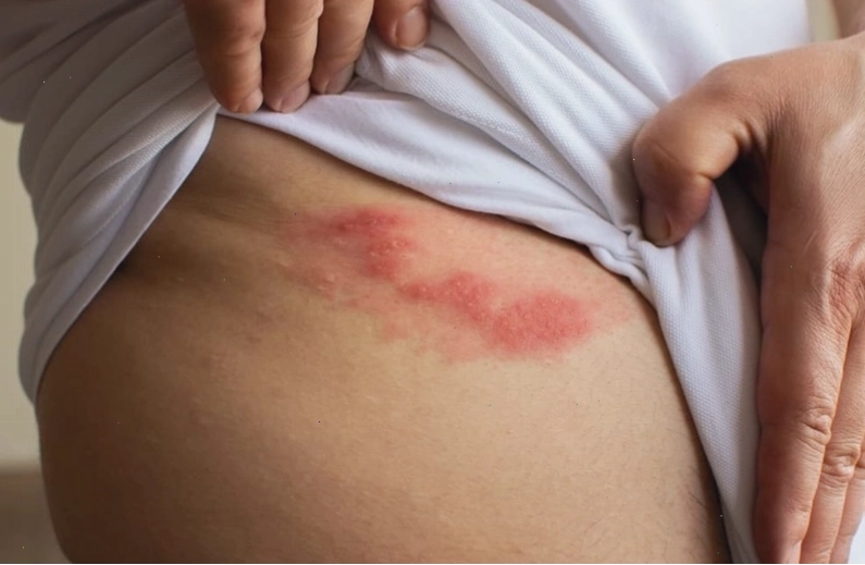 Người bệnh cảm thấy đau rát như bị châm chích tại vùng da bị zona