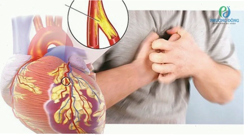 Người mắc hội chứng Turner có nguy cơ mắc bệnh tim mạch cao
