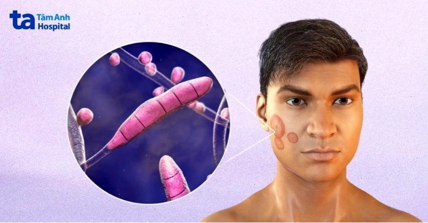 Nhiều chủng loại nấm da mặt khác nhau gây ra các biểu hiện đa dạng