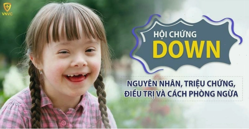 Những đặc điểm thể chất thường thấy ở trẻ mắc hội chứng Down