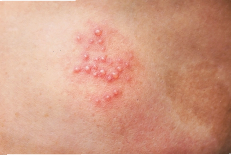 Những mụn nước nhỏ li ti trên vùng da bị bệnh zona
