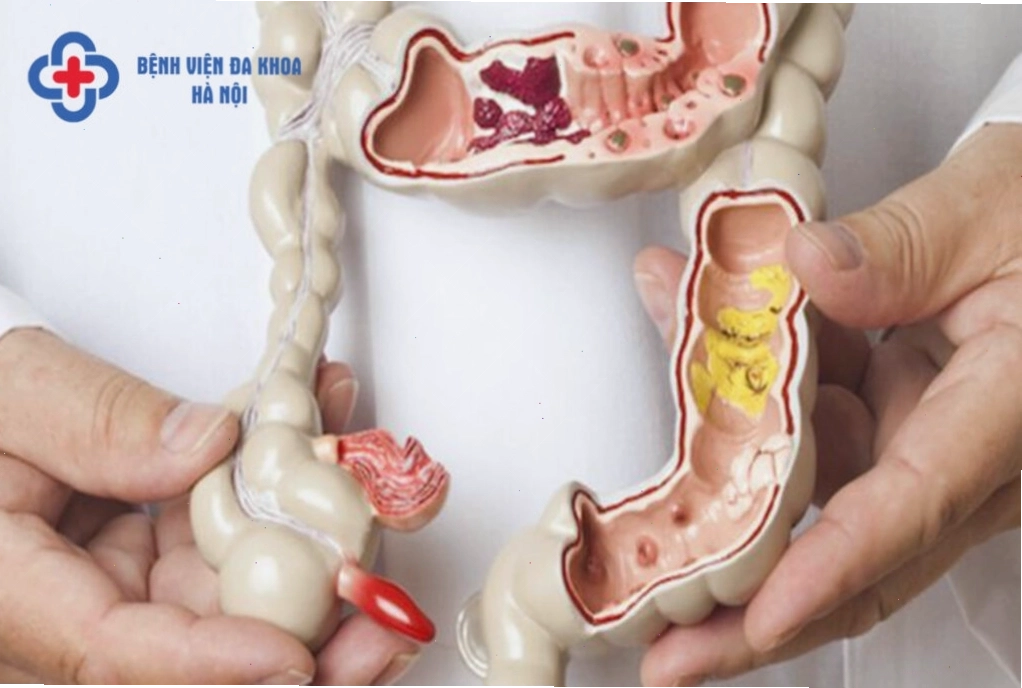 Phụ nữ nên đi khám bác sĩ khi có dấu hiệu bệnh trĩ