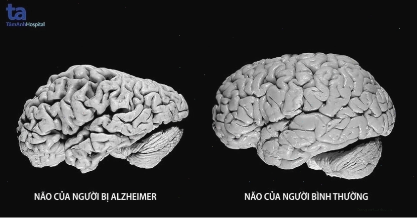 So sánh hình ảnh não bộ người khỏe mạnh và não bộ người mắc bệnh Alzheimer
