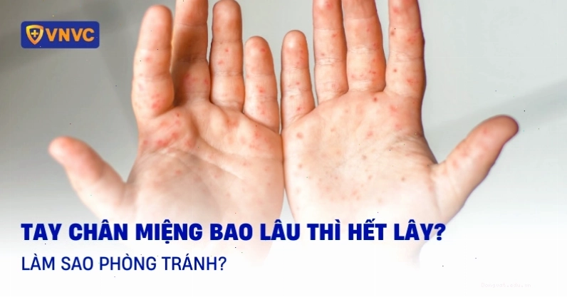 Thời gian lây nhiễm của bệnh tay chân miệng