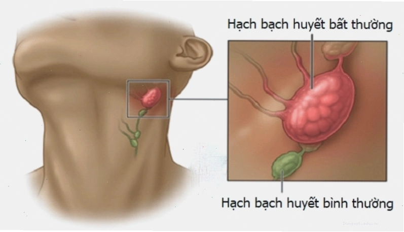 Triệu chứng của bệnh AIDS