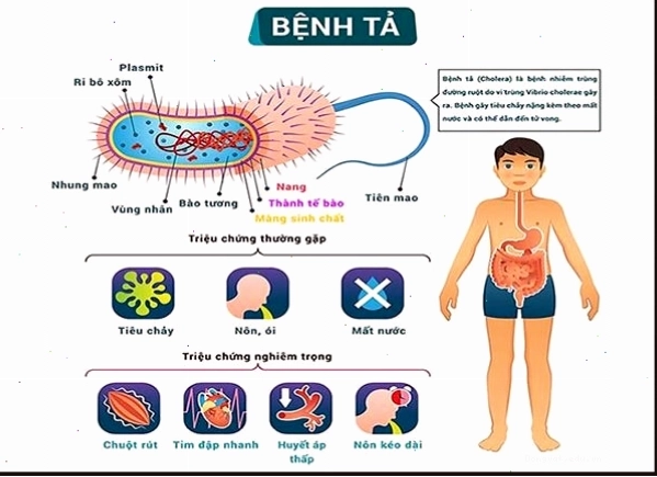 Triệu chứng tiêu chảy cấp tính do bệnh tả