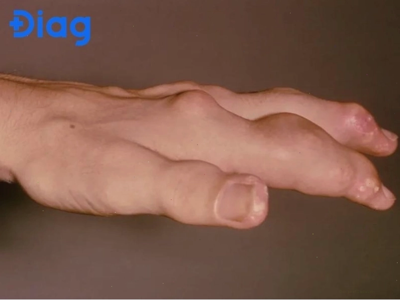 Xét nghiệm máu kiểm tra axit uric là bước quan trọng để phát hiện nguy cơ gút