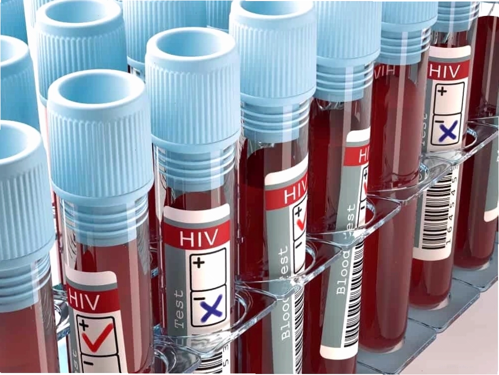 Xét nghiệm và chẩn đoán bệnh aids là gì?